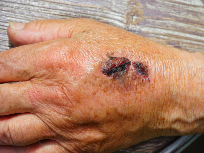 https://pixabay.com/photos/hand-injury-skin-abrasion-gall-474279/